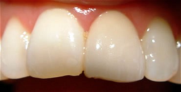 Smile Gallery Before After photos of Veneers