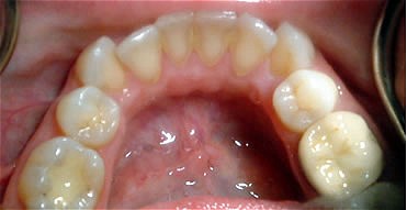 Smile Gallery Before After photos of Lower Invisalign