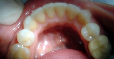 Smile Gallery Before After photos of Lower Invisalign