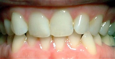 Smile Gallery Before After photos of Front Invisalign