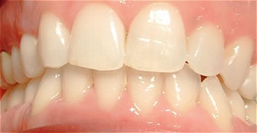 Smile Gallery Before After photos of Front Invisalign