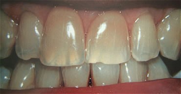Smile Gallery Before After photos of Whitening