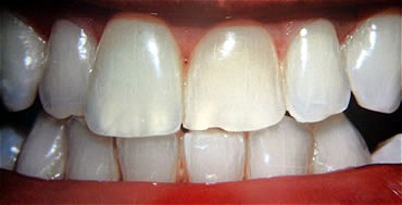 Smile Gallery Before After photos of Whitening