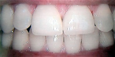 Smile Gallery Before After photos of Veneers