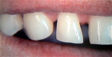 Smile Gallery Before After photos of Veneers