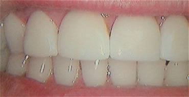 Smile Gallery Before After photos of Veneers